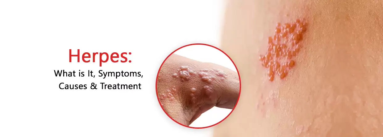 Herpes: What is It, Symptoms, Causes & Treatment